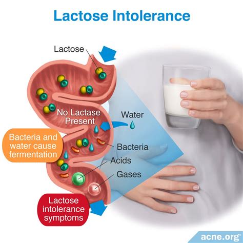 dating lactose intolerant
